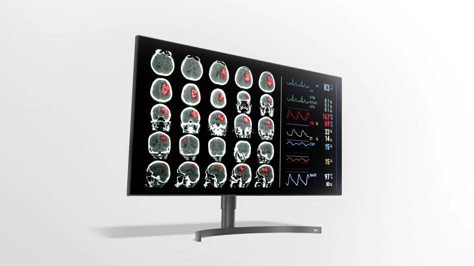 Monitor de diagnóstico IPS LG de 31.5″ y 8 MP Monitor de diagnóstico IPS LG de 31.5